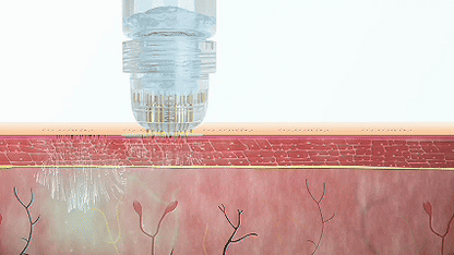 Advanced Micro - Infusion Hair Regrowth Kit