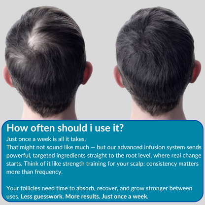 SPARTAN Advanced Micro - Infusion Hair Regrowth Kit