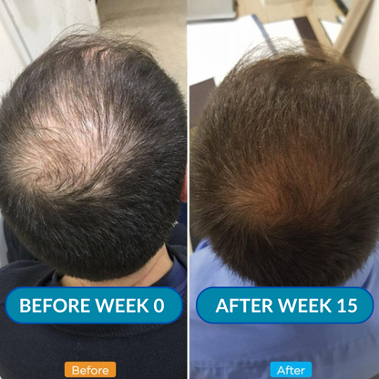 SPARTAN Advanced Micro - Infusion Hair Regrowth Kit